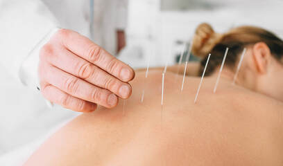 Acupuncture practitioner performs treatment on female patient in a Lehigh Valley wellness clinic.